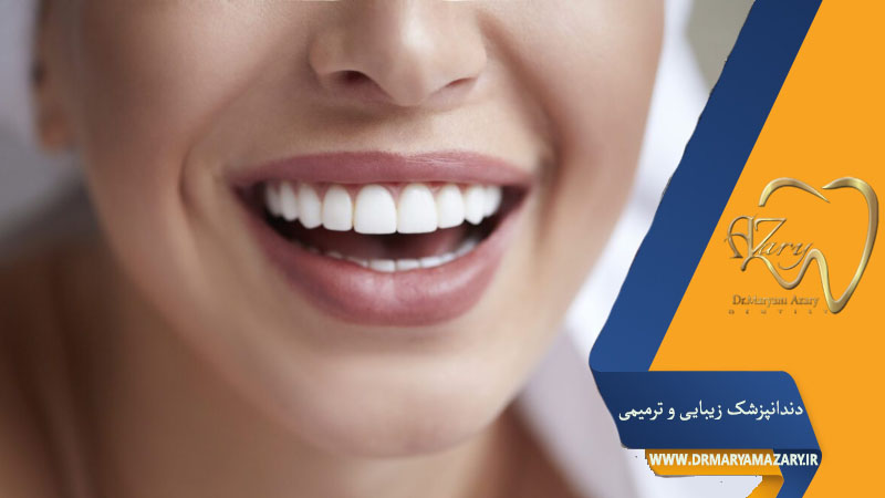 روکش های زیبایی دندان اصفهان