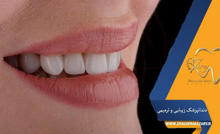 لمینت سرامیکی دندان اصفهان