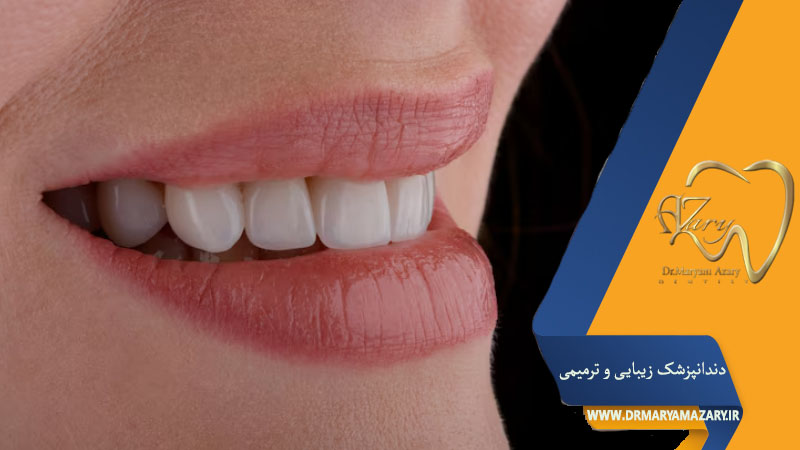 لمینت سرامیکی دندان اصفهان