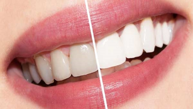 بلیچینگ اصفهان