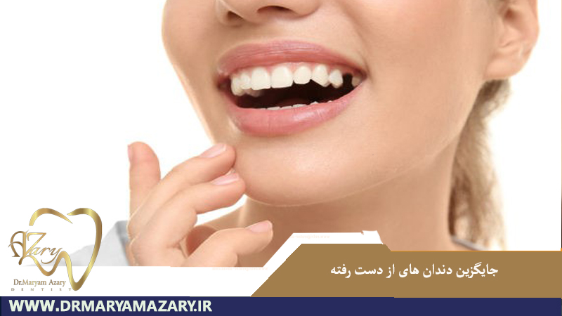 جایگزین دندان های از دست رفته