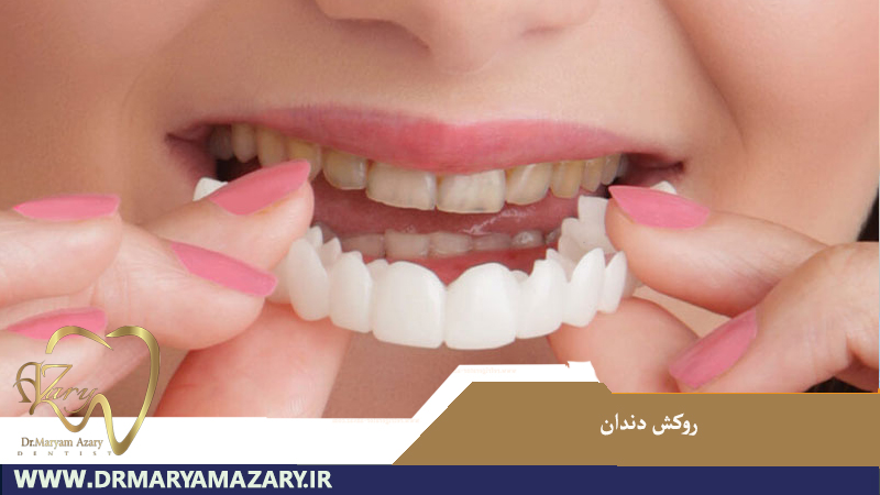 روکش دندان