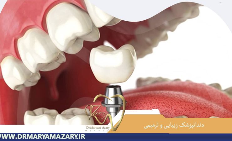ایمپلنت های دندانی