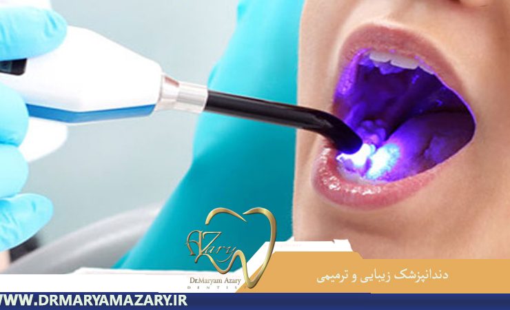 سفید کردن دندان در اصفهان