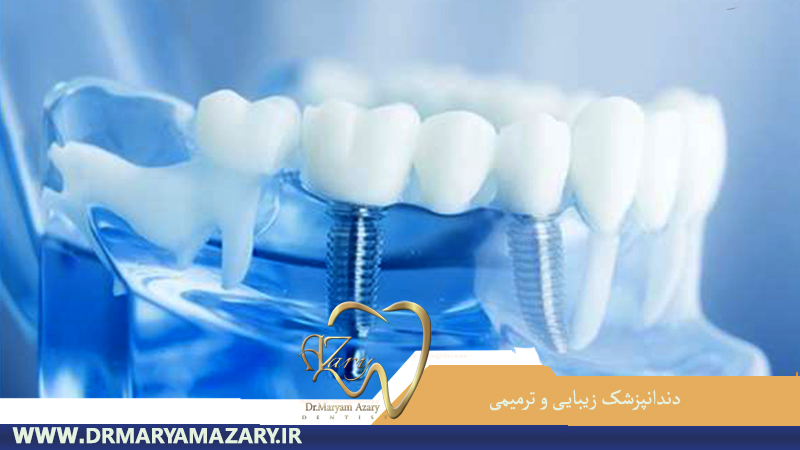 دندانپزشک-زیبایی-ترمیمی-اصفهان | دکتر-مریم-آذری