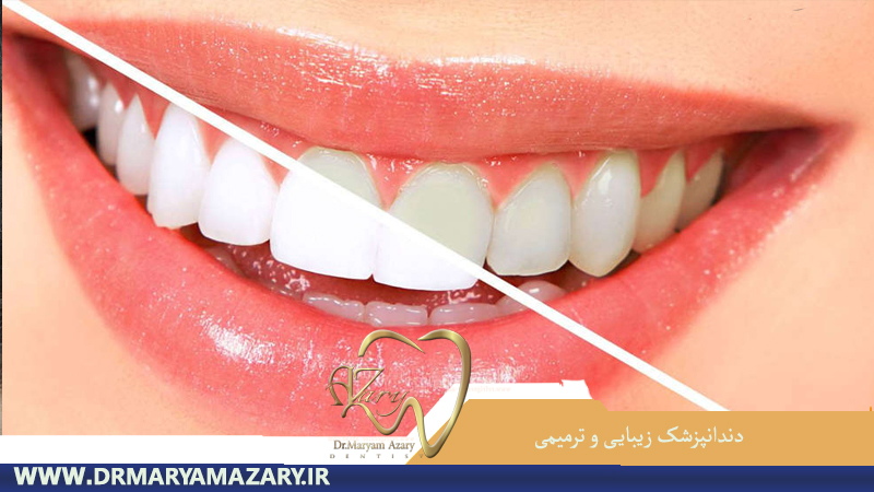 دندانپزشک-زیبایی-ترمیمی-اصفهان | دکتر-مریم-آذری