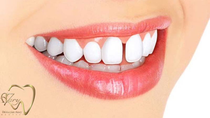 دندانپزشک-زیبایی-ترمیمی-اصفهان | دکتر-مریم-آذری