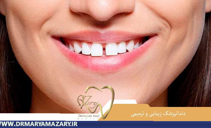 دندانپزشک-زیبایی-ترمیمی-اصفهان | دکتر-مریم-آذری