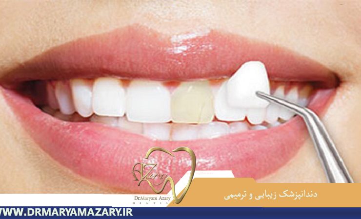 دندانپزشک-زیبایی-ترمیمی-اصفهان | دکتر-مریم-آذری