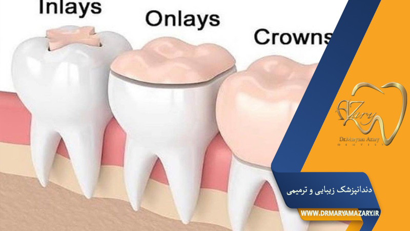 دندانپزشک-زیبایی-ترمیمی-اصفهان | دکتر-مریم-آذری