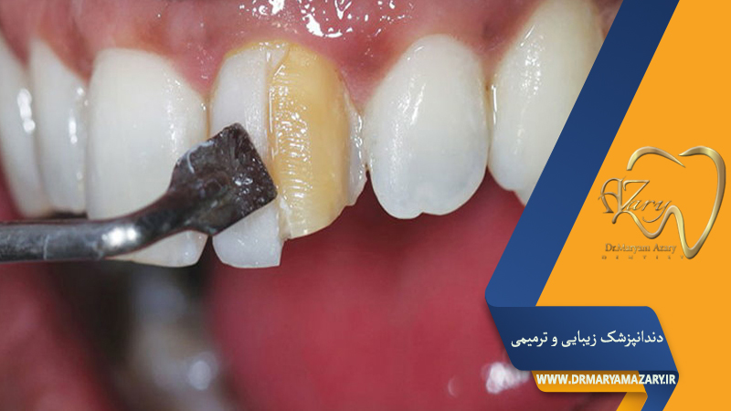 دندانپزشک-زیبایی-ترمیمی-اصفهان | دکتر-مریم-آذری