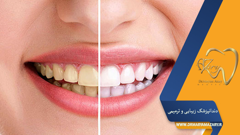 دندانپزشک زیبایی ترمیمی اصفهان | دکتر مریم آذری