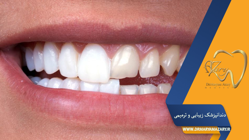 دندانپزشک زیبایی ترمیمی اصفهان  | دکتر مریم آذری