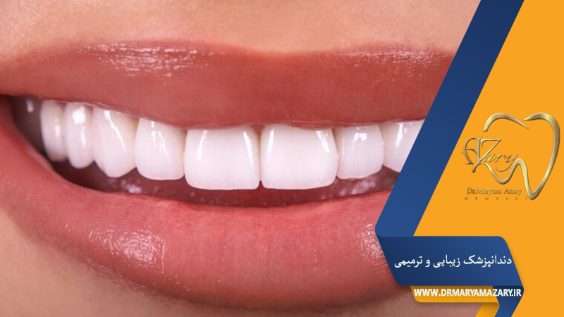 دندانپزشک زیبایی ترمیمی اصفهان  | دکتر مریم آذری