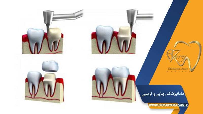 دندانپزشک زیبایی ترمیمی اصفهان  | دکتر مریم آذری