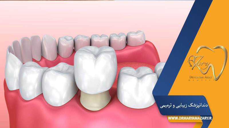 دندانپزشک زیبایی ترمیمی اصفهان  | دکتر مریم آذری