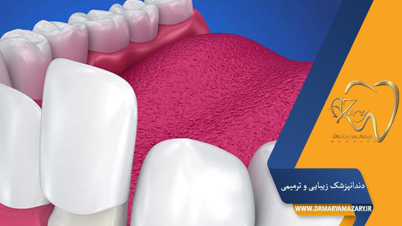 دندانپزشک زیبایی ترمیمی اصفهان  | دکتر مریم آذری