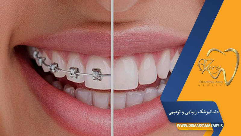 دندانپزشک زیبایی ترمیمی اصفهان  | دکتر مریم آذری