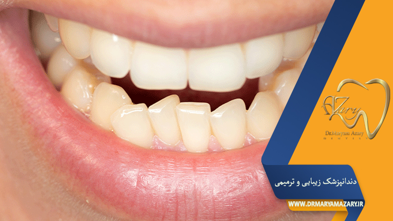 دندانپزشک زیبایی ترمیمی اصفهان  | دکتر مریم آذری