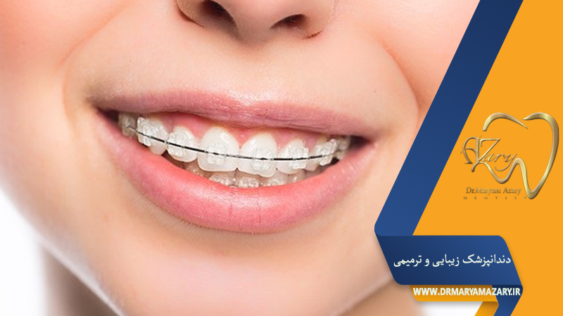 دندانپزشک زیبایی ترمیمی اصفهان  | دکتر مریم آذری