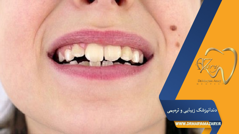 دندانپزشک زیبایی ترمیمی اصفهان  | دکتر مریم آذری