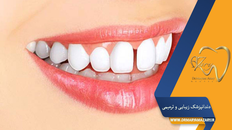دندانپزشک زیبایی ترمیمی اصفهان  | دکتر مریم آذری