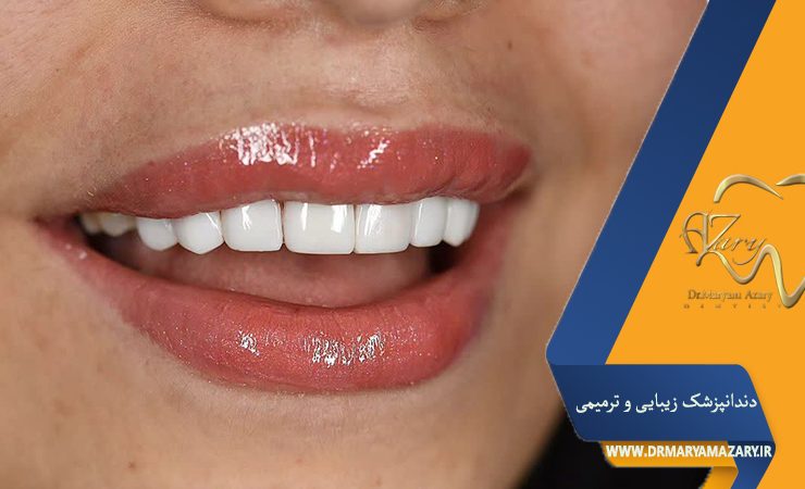 کامپوزیت یا ایمپلنت