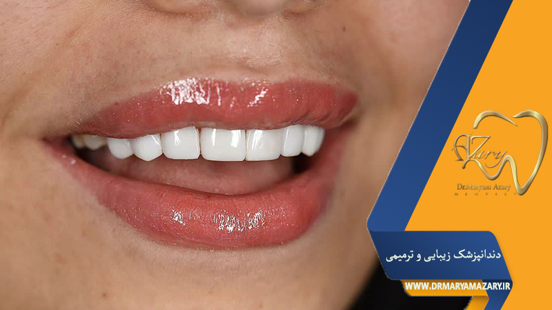 کامپوزیت یا ایمپلنت