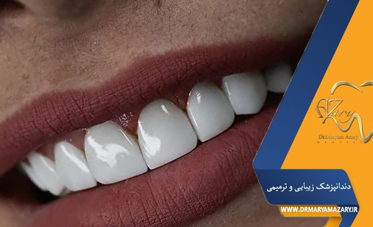 لمینت دندان در دوران بارداری