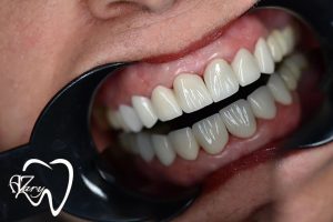 کامپوزیت دندان