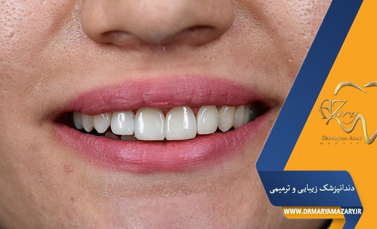 لمینت یا کامپوزیت