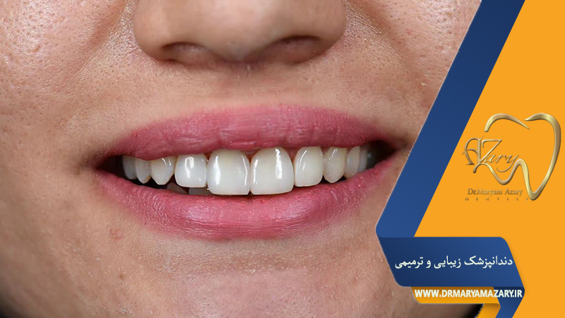 لمینت یا کامپوزیت