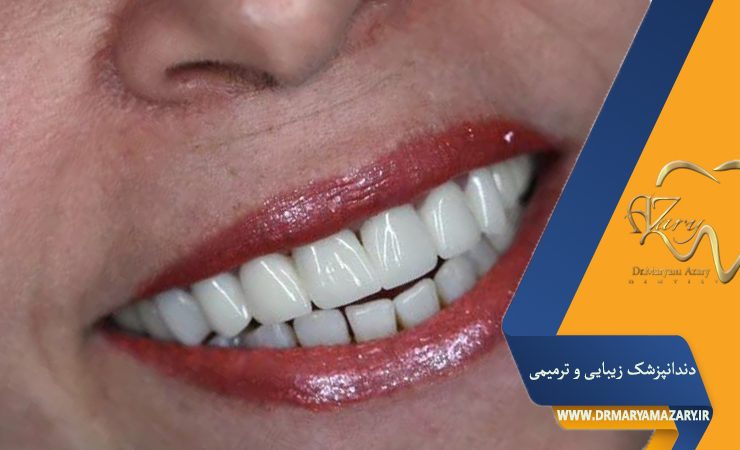 پوسیدگی دندان با کامپوزیت