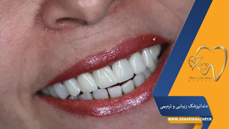 پوسیدگی دندان با کامپوزیت