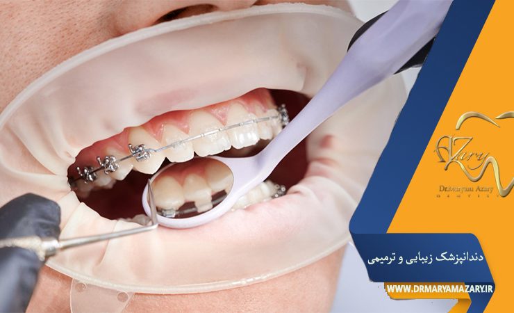 تأثیر سیگار بر سلامت دندانها و راهکارهای پیشگیری