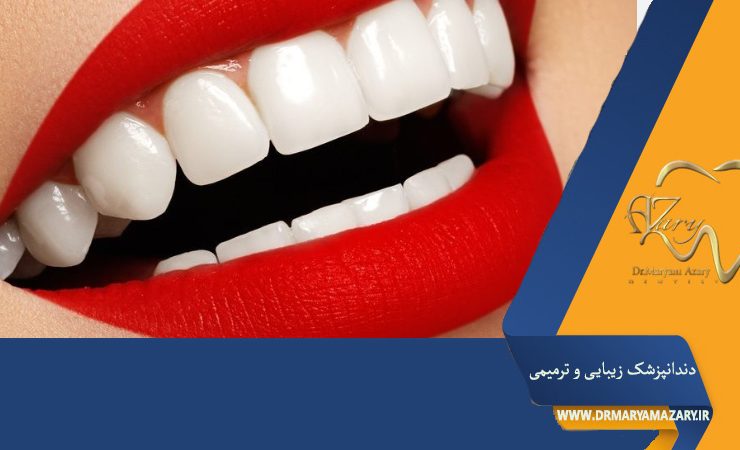 مزایا و معایب لمینت دندان