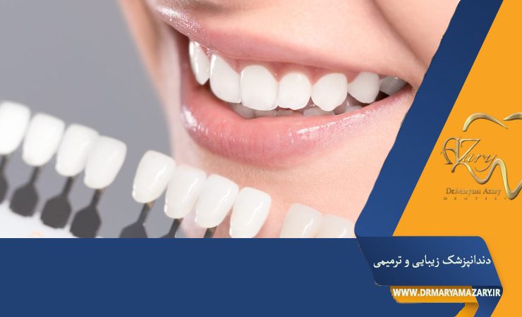 تاثیر لمینت دندان بر رنگ دندان ها