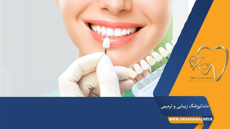 قیمت لمینت دندان