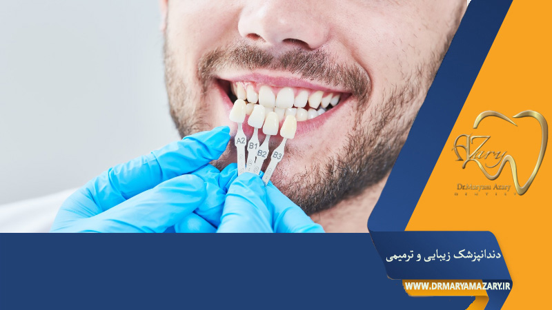 لمینت دندان و تاثیر آن بر اعتماد به نفس