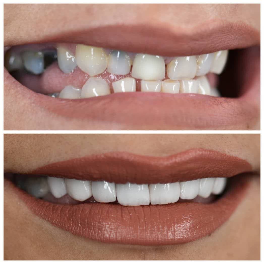 کامپوزیت دندان اصفهان