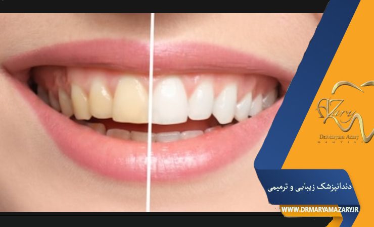 درمان خانگی زردی دندان