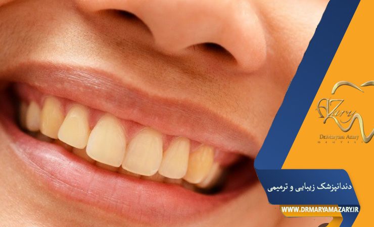 جرم گیری دندان و نکات آن