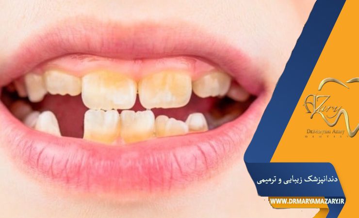 فواید و اهمیت جرم‌گیری دندان