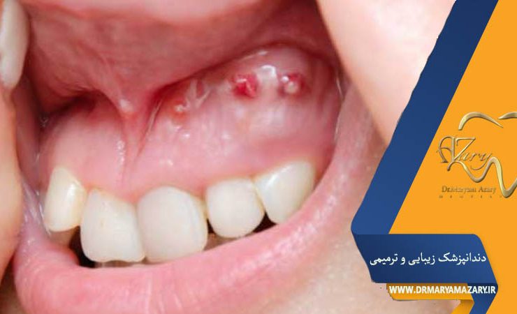 آیا کیست لثه خطرناک است؟