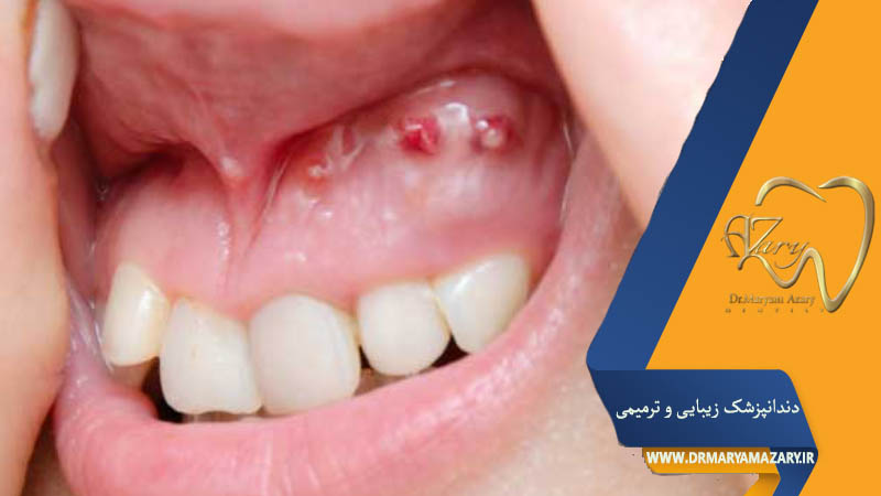 آیا کیست لثه خطرناک است؟