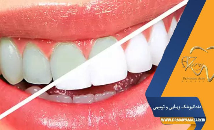 کیت سفید کننده دندان