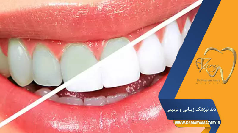 کیت سفید کننده دندان