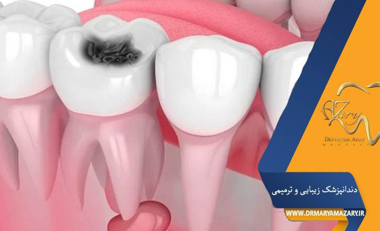 کیست دندان چیست؟