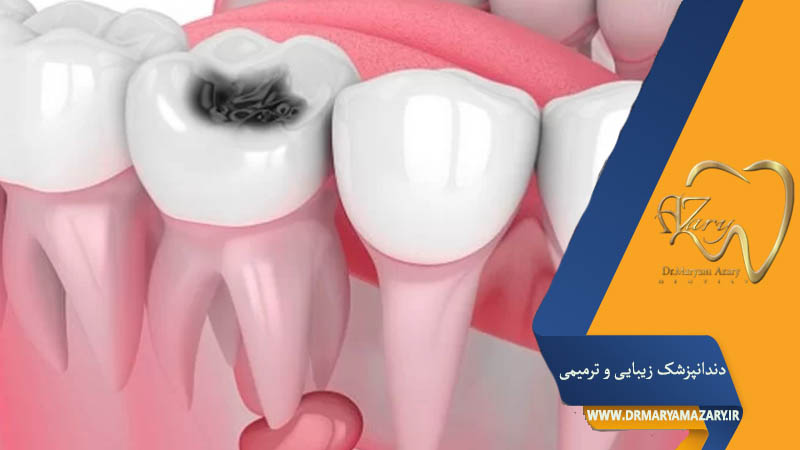 کیست دندان چیست؟