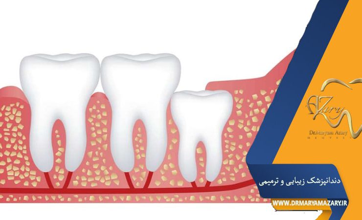 کشیدن دندان نهفته